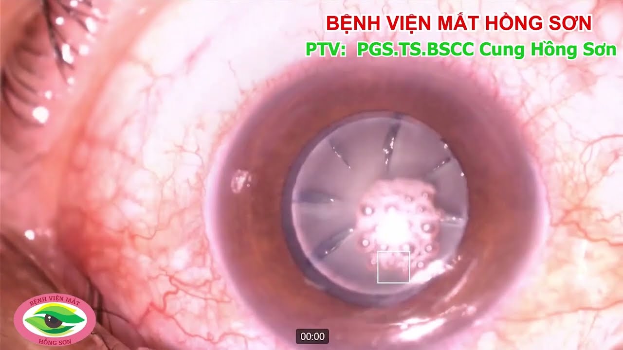 Phẫu thuật đục thủy tinh thể bằng laser Femtosecond (Femtosecond laser assisted cataract surgery)